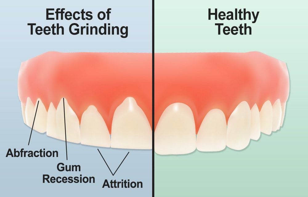 stop grinding my teeth naturally