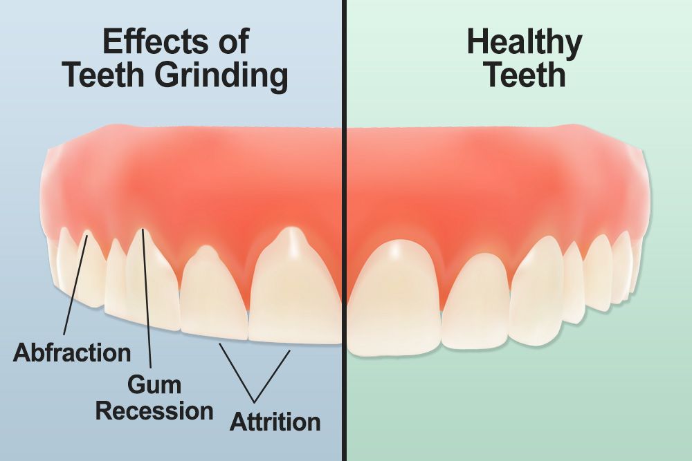 I don’t grind my teeth… Do I? Brilliance Dental Care